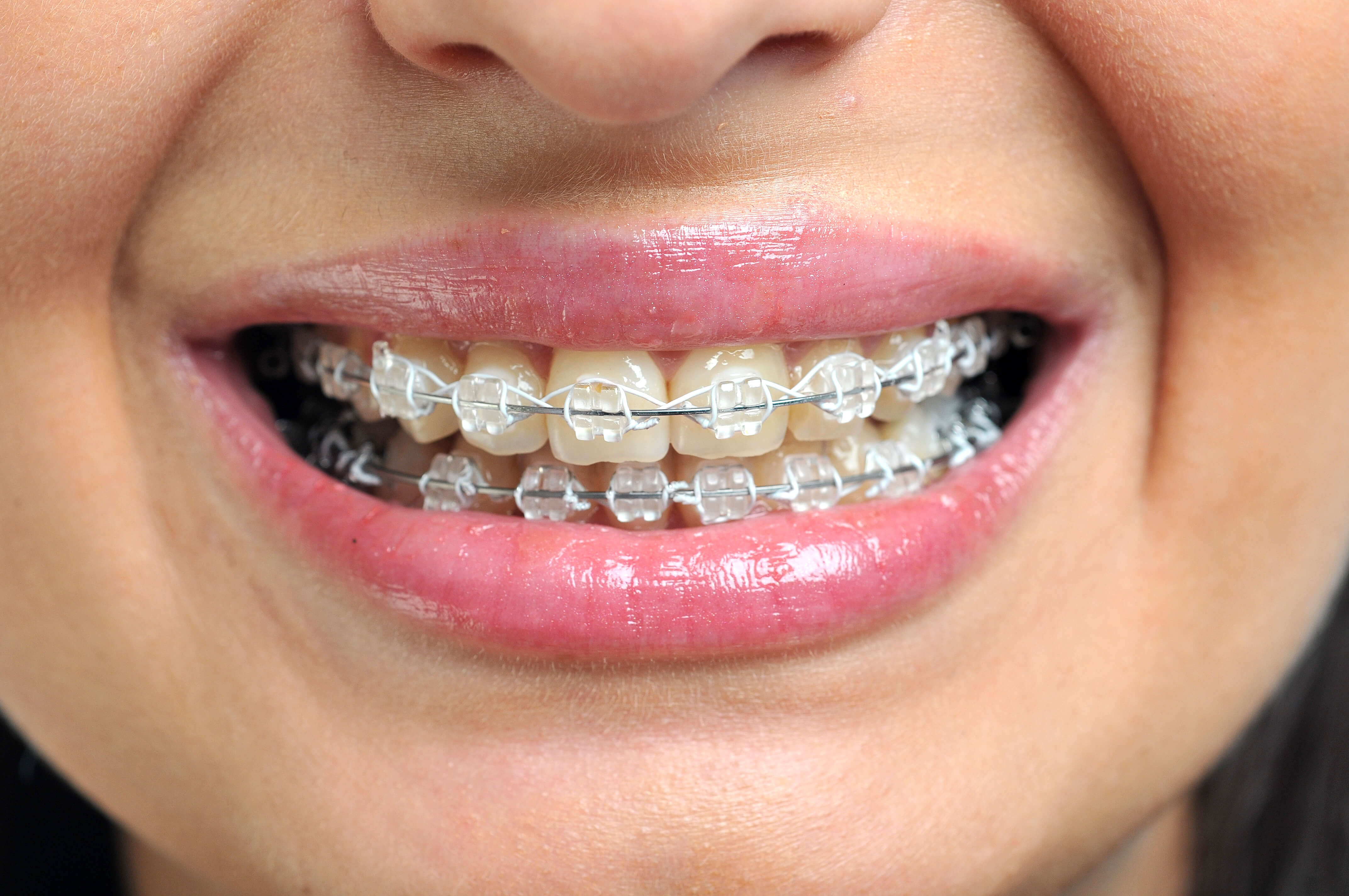 Clear Braces in Andover & Lawrence, MA